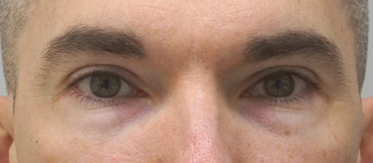 Alalaugude plastika (Blefaroplastika) enne