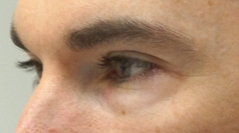 Alalaugude plastika (Blefaroplastika) enne