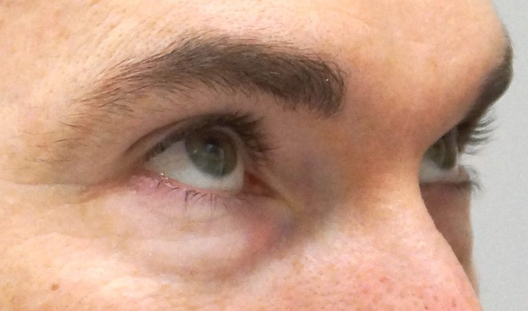 Alalaugude plastika (Blefaroplastika) enne