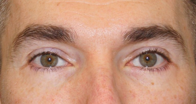 Alalaugude plastika (Blefaroplastika) pärast