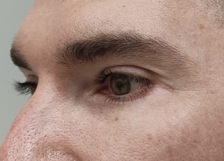 Alalaugude plastika (Blefaroplastika) pärast