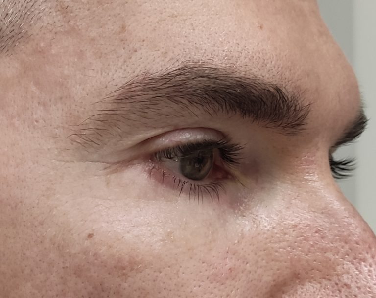 Alalaugude plastika (Blefaroplastika) pärast