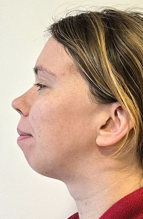 Genioplastika osteotoomia ja lõuatsi nihutamine enne