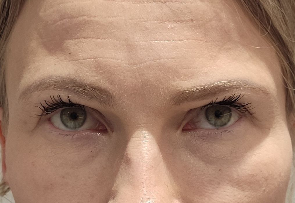 Kulmude tõstmine (Brow Lift) enne