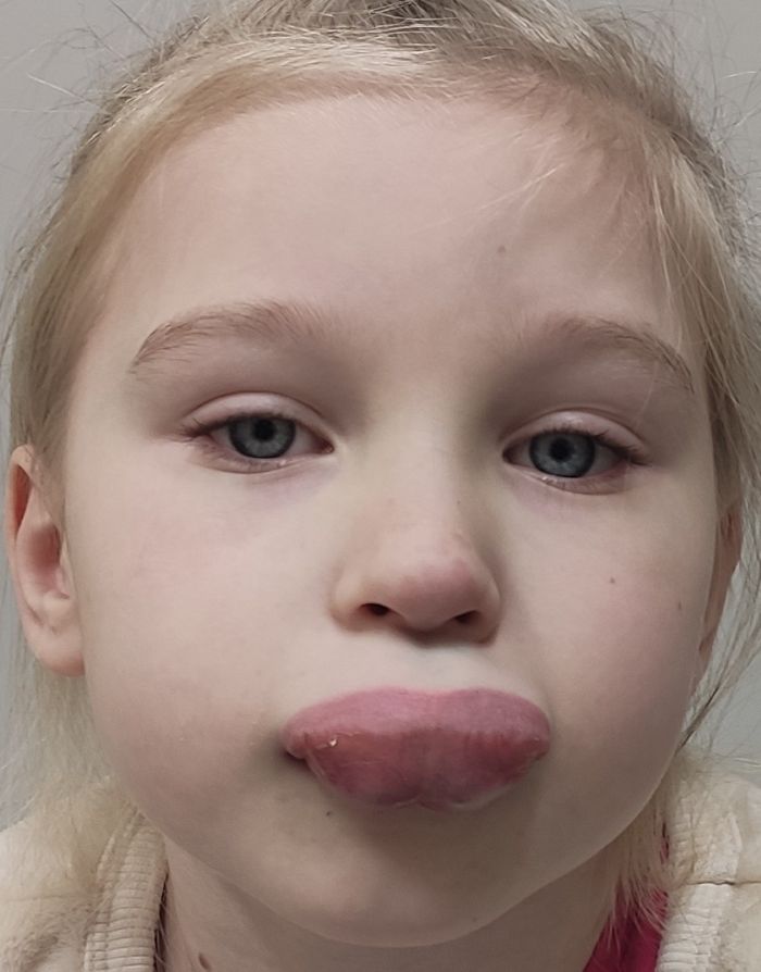 Ülahuule hemangioomi kirurgiline eemaldamine enne