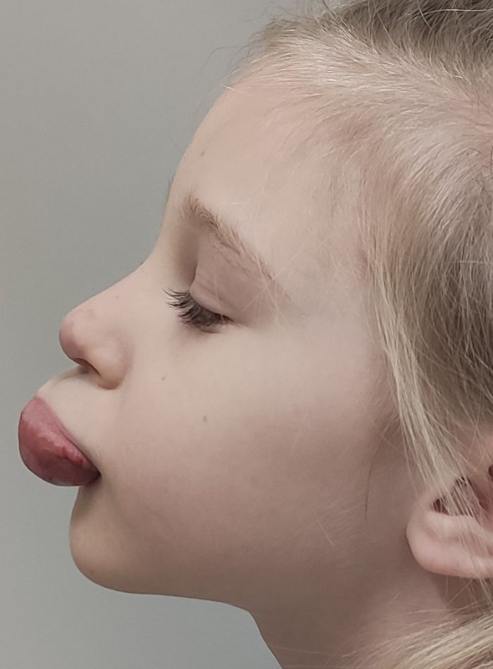 Ülahuule hemangioomi kirurgiline eemaldamine enne