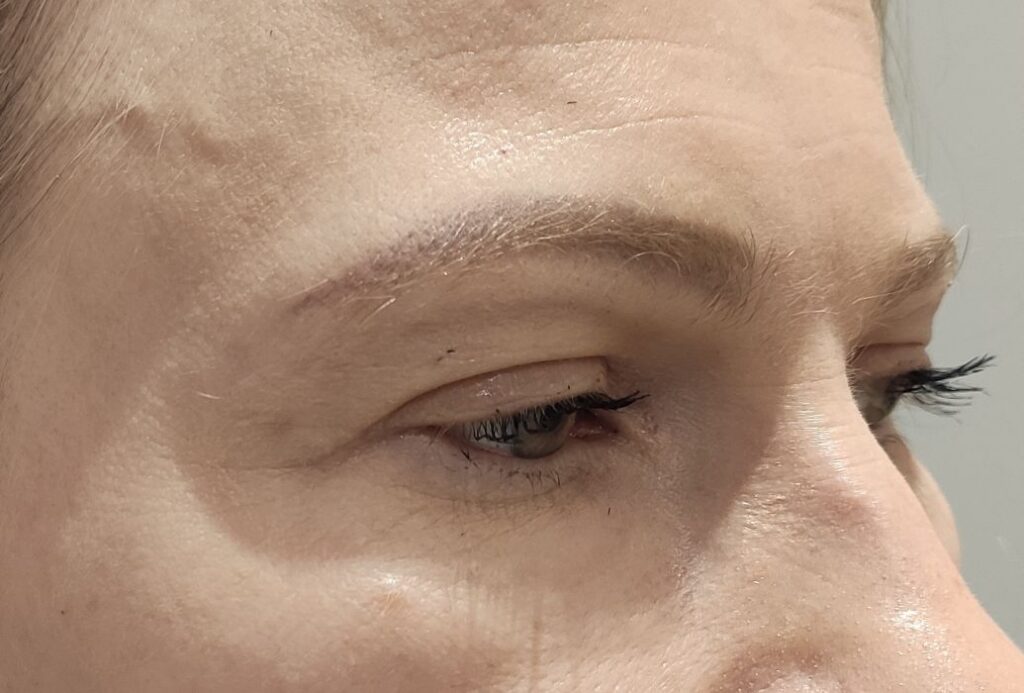 Kulmude tõstmine (Brow Lift) enne