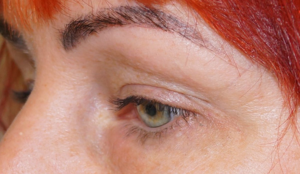 Ülalaugude blefaroplastika enne