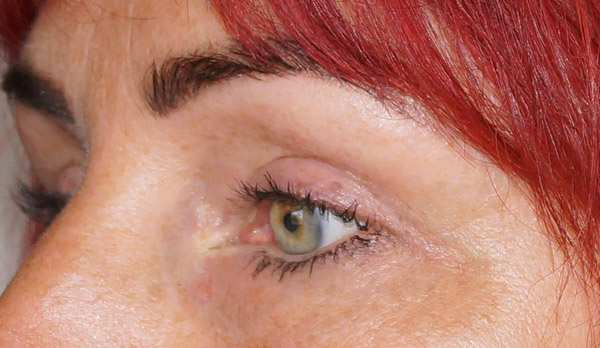 Ülalaugude blefaroplastika pärast