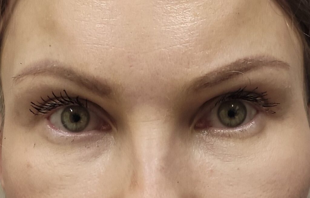 Kulmude tõstmine (Brow Lift) pärast