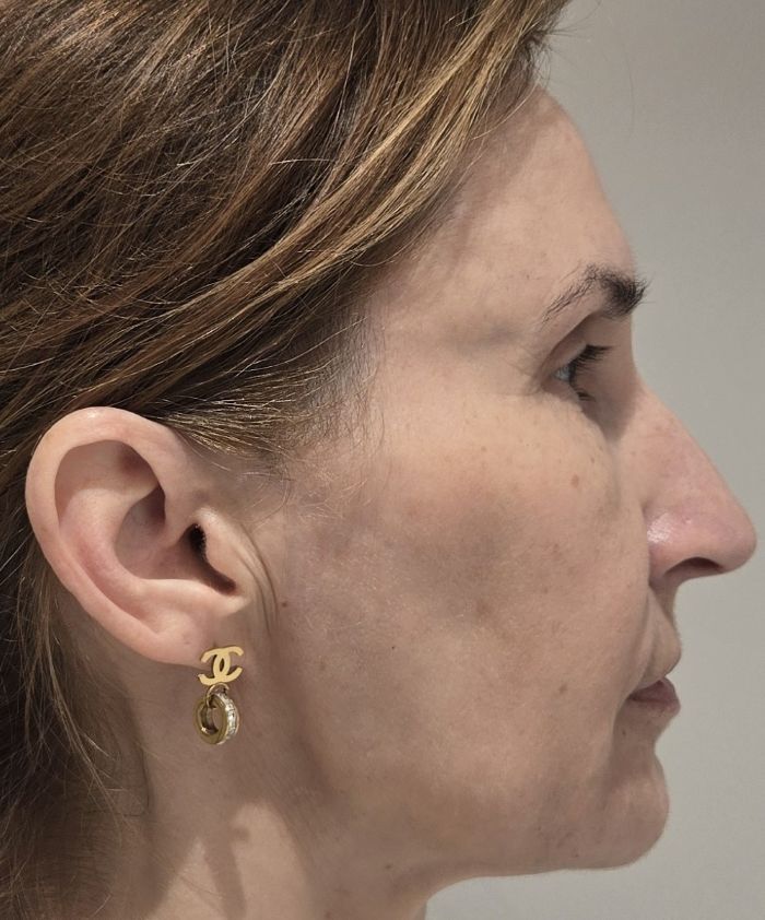 Rasva siirdamine põse ja oimu piirkonda pärast