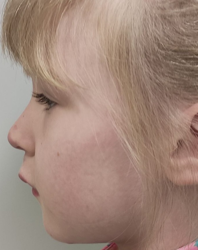 Ülahuule hemangioomi kirurgiline eemaldamine pärast