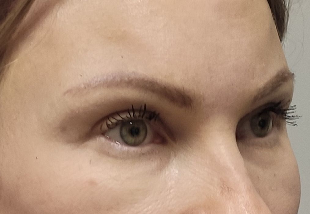 Kulmude tõstmine (Brow Lift) pärast