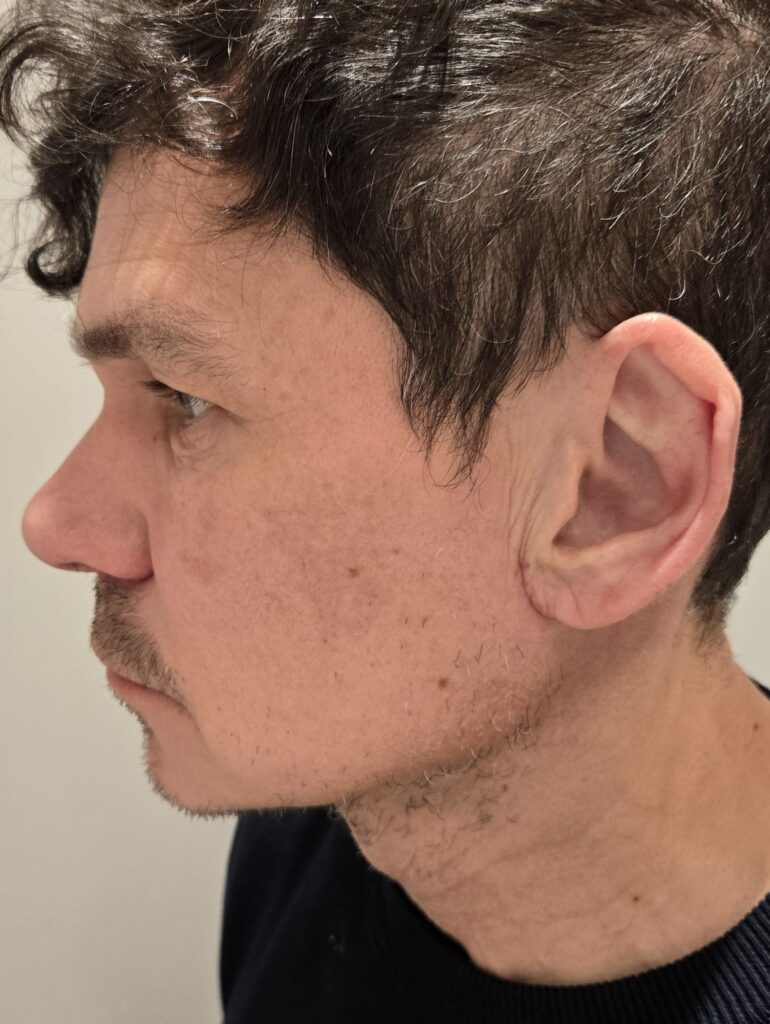 Kaela Plastika pärast
