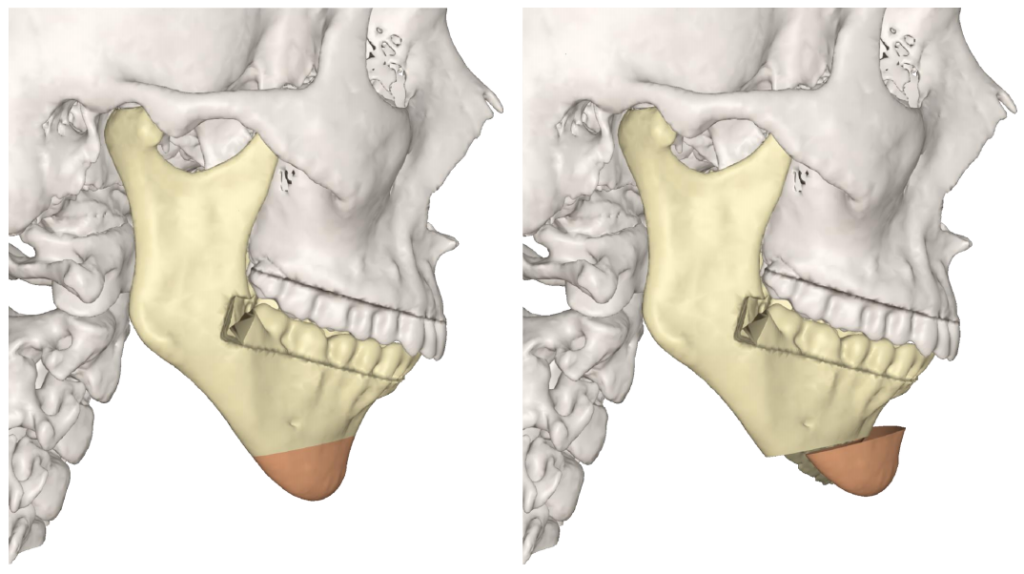 Genioplastika osteotoomia ja lõuatsi nihutamise teel (3D planeerimisega) 3D simulatsioon