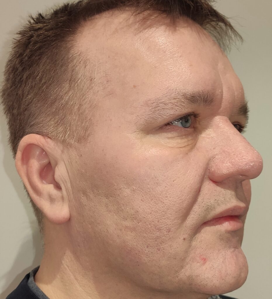 Üla- ja alalaugude plastika, botox kogu näole ning täitesüst enne