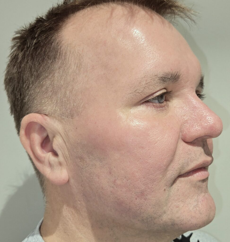 Üla- ja alalaugude plastika, botox kogu näole ning täitesüst pärast
